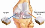 Гонартроз коленного сустава 1 степени лечение медикаментами