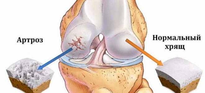Гонартроз коленного сустава 1 степени лечение медикаментами