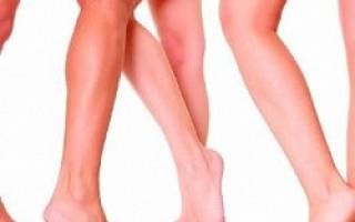 Признаки варикоза на ногах у женщин