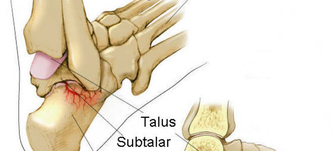 Артроз таранно пяточного сустава