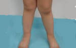 Ноги иксом у ребенка 2 года фото