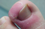 Воспаление возле ногтя на большом пальце ноги
