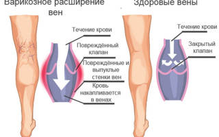 Гимнастика для ног при варикозе нижних конечностей