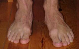 Лечение вальгусной деформации большого пальца стопы