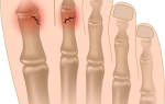 Как зафиксировать сломанный палец на ноге
