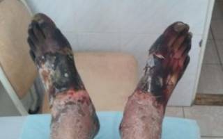 Первая помощь при обморожении ног