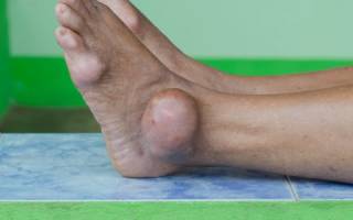 Полиартрит пальцев ног симптомы и лечение