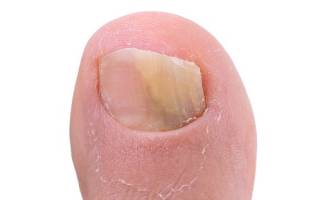 Лечение онихомикоза ногтей на ногах препараты