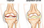 Подагра коленного сустава симптомы лечение