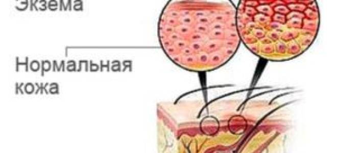 Экзема на пятке чем лечить