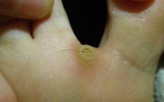 Мозоль на пальце ноги со стержнем лечение
