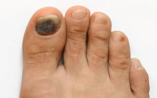 Удаление ногтя на большом пальце ноги грибок