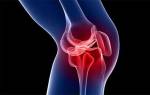 Симптомы бурсита коленного сустава
