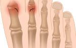 Симптомы сломанного пальца на ноге большой