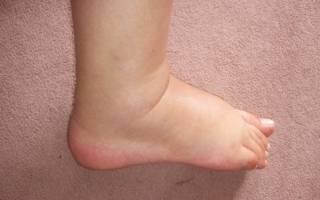Опухла стопа левой ноги причины и лечение