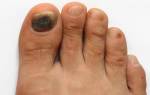 Почему чернеют ногти на больших пальцах ног