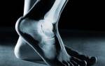 Заболевания стопы ног фото и описание