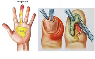 Мазь от гноя на пальце ноги