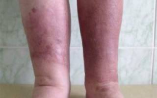 Нога отекла и покраснела рожистое воспаление фото