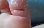 Трещина на пальце ноги у ребенка
