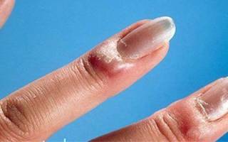 Как лечить нарыв на пальце около ногтя
