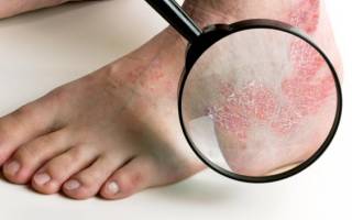 Эффективное средство от псориаза на ногах