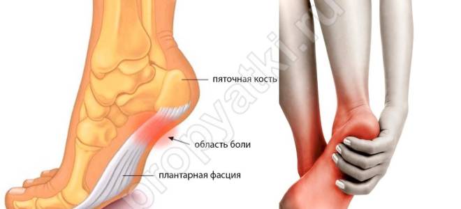Воспаление фасции стопы как лечить