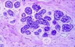 Базально клеточная гиперплазия