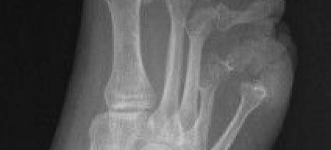 Боль на стопе под пальцами при ходьбе