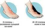 Обморожение ног симптомы