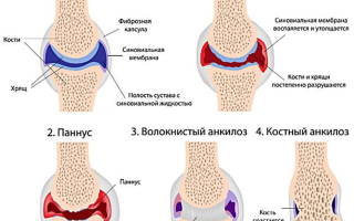 Ревматоидный артрит критерии диагностики