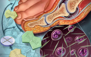 Как лечить подагрический артрит