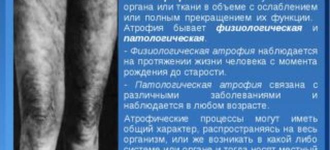 Гипотрофия мышц голени