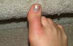 Почему синеют ногти на больших пальцах ног