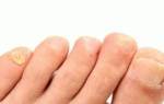Ногти трескаются вдоль сверху ногтевой пластины причина