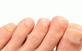 Ногти трескаются вдоль сверху ногтевой пластины причина