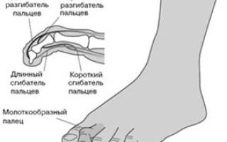 Искривление второго пальца на ноге