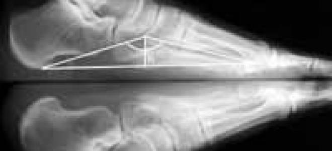 Высота свода стопы норма