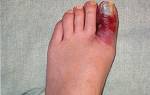 Ушиб большого пальца ноги симптомы