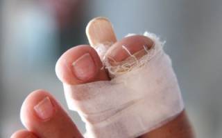 Первая помощь при переломе пальца на ноге