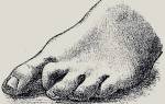 Молоткообразная деформация пальцев стопы лечение