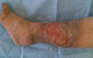 Трофическая язва на ноге лечение в домашних