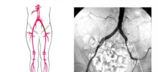 Протез бедренной артерии