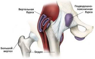 Трохантерный бурсит