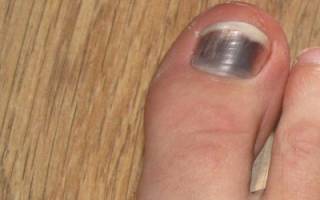 Синий палец на ноге после удара