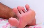 Зуд между пальцами ног причины и лечение