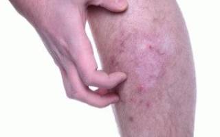 Зуд голени ног причина лечение