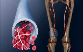 Профилактика тромбов в ногах