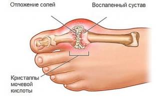 Подагра способы лечения