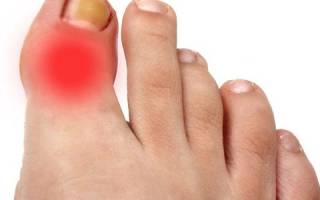 Боль в области большого пальца на ноге